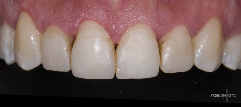 Figure 2: Healthy Gingival Tissue